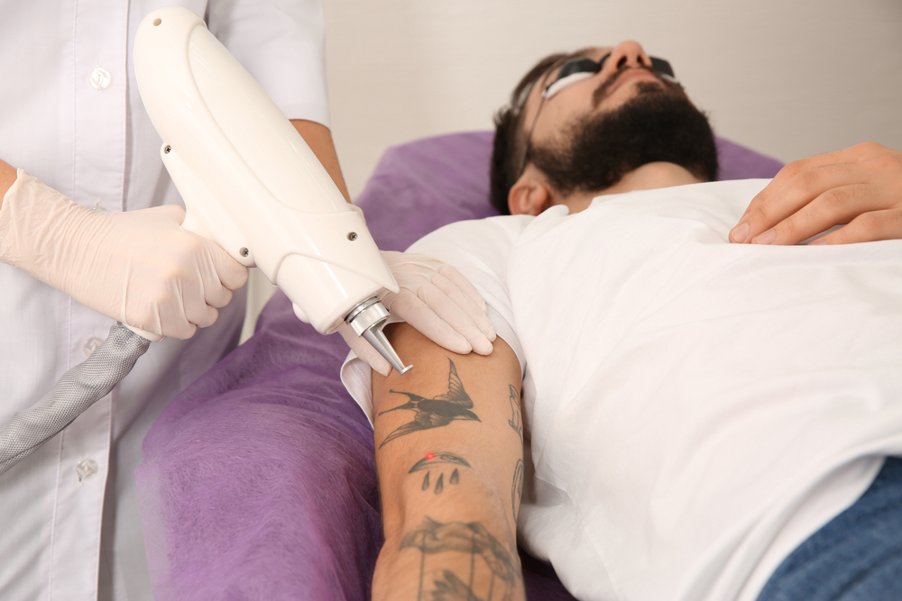 Lazerle Dövme Silme Nasıl Yapılır Hakkında Bilgiler