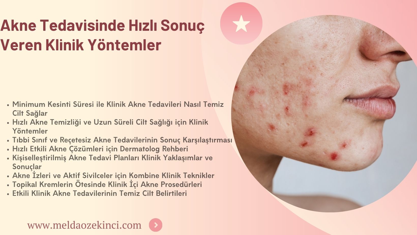 Akne Tedavisinde Hızlı Sonuç Veren Klinik Yöntemler
