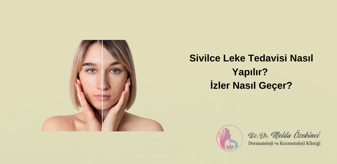 Sivilce İzi Tedavisi