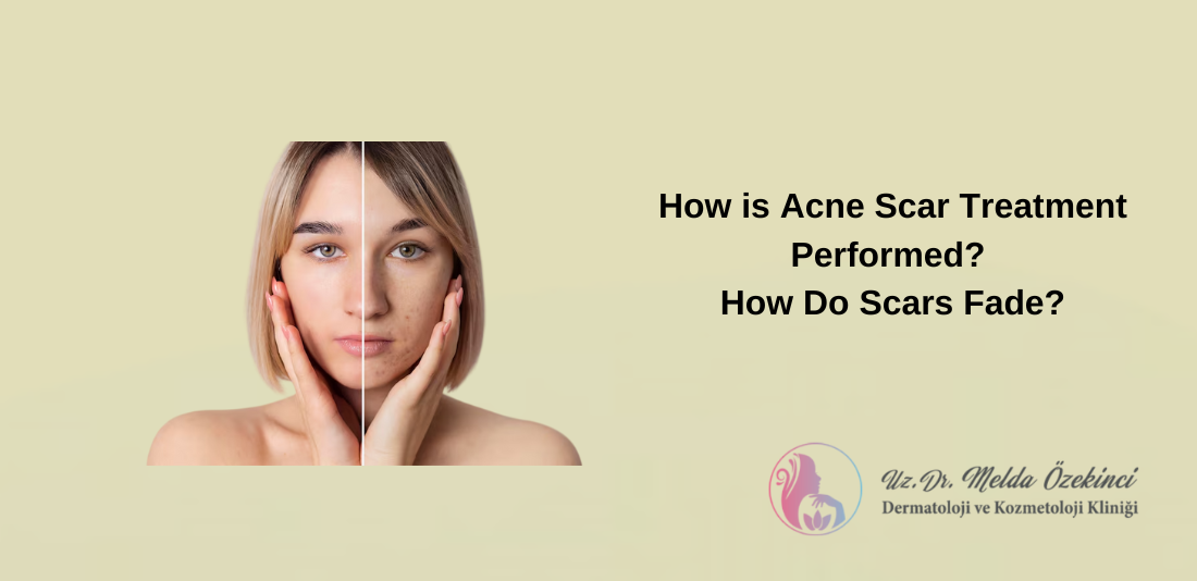 Acne Scar Treatment