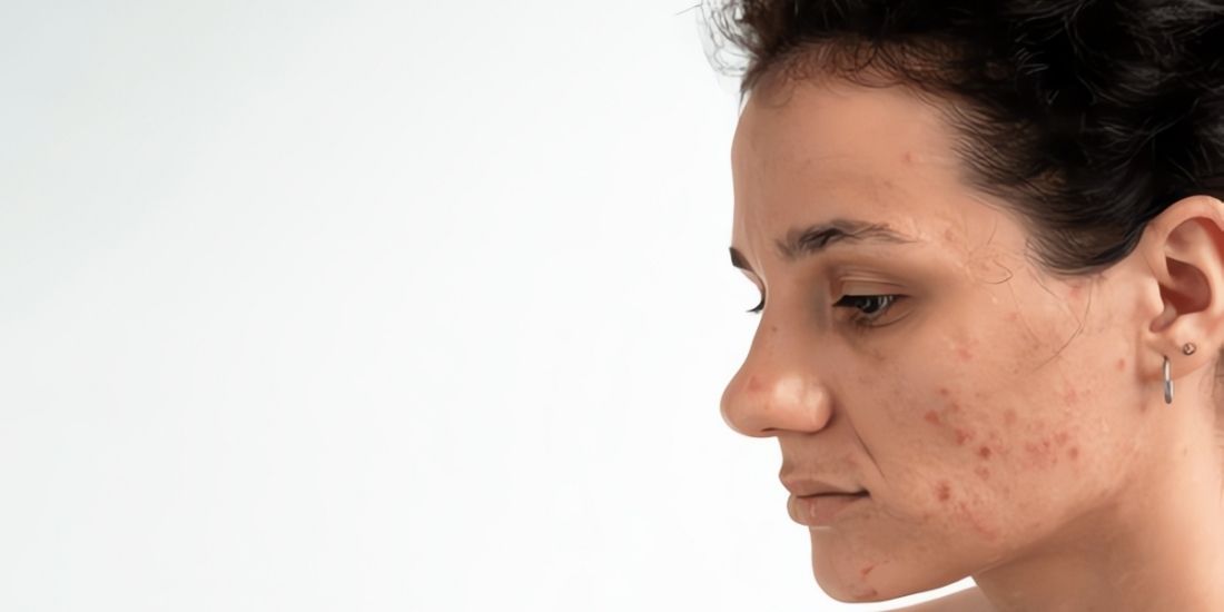 Which Acne Scar Treatment Is Right for You? A Comparison of Laser, Dermapen, and Gold Needle Treatments
