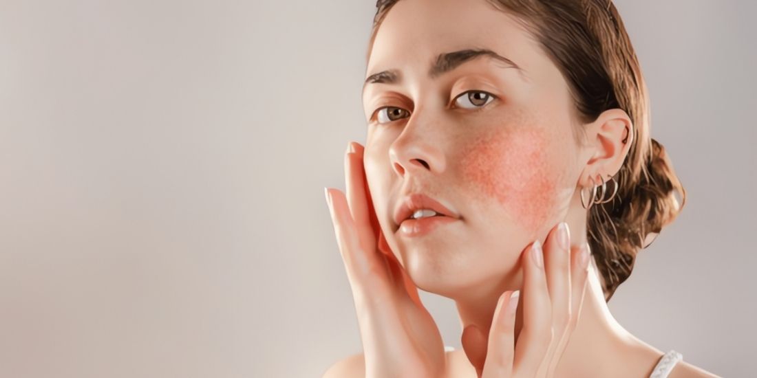 What Should a Daily Skincare Routine for Rosacea Look Like?