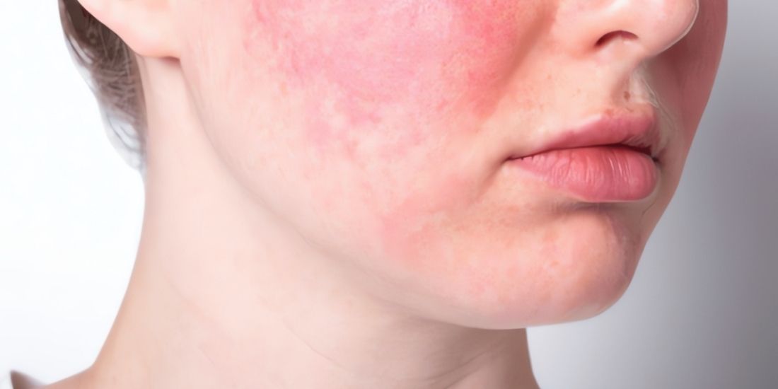 Rosacea Belirtileri ve Tedavi Süreci