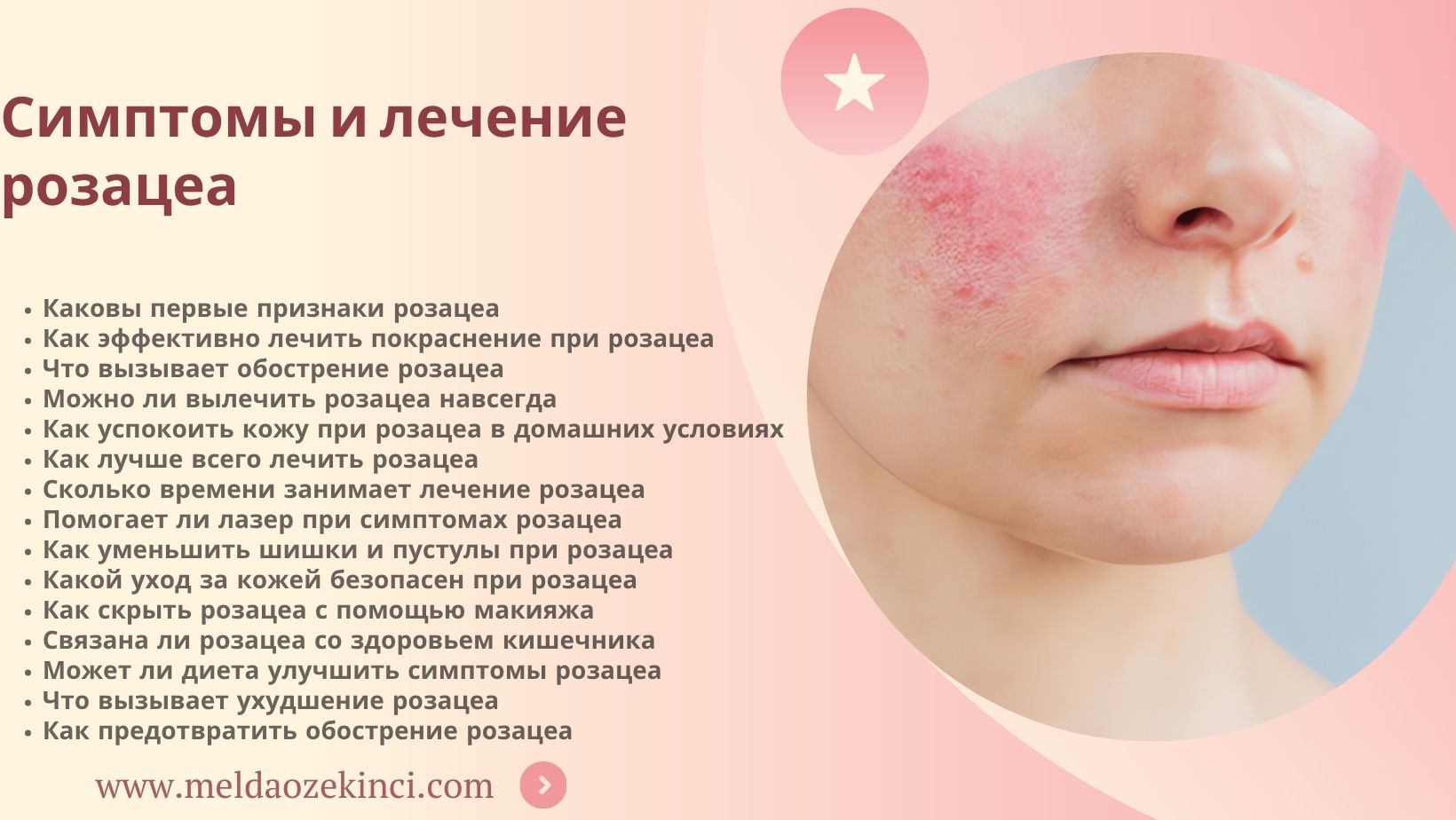 Симптомы розацеа и процесс лечения