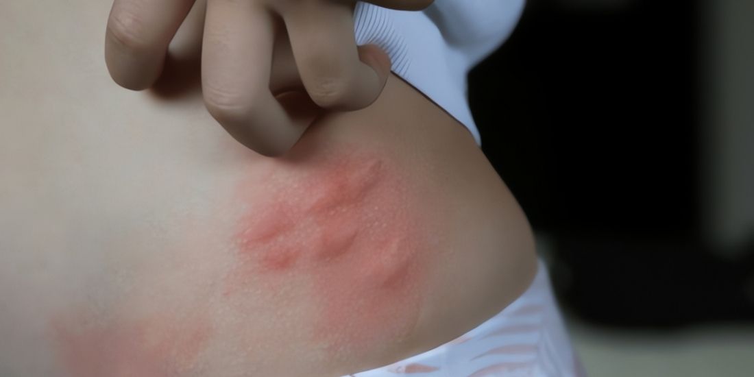 Как лечить покраснение кожи?