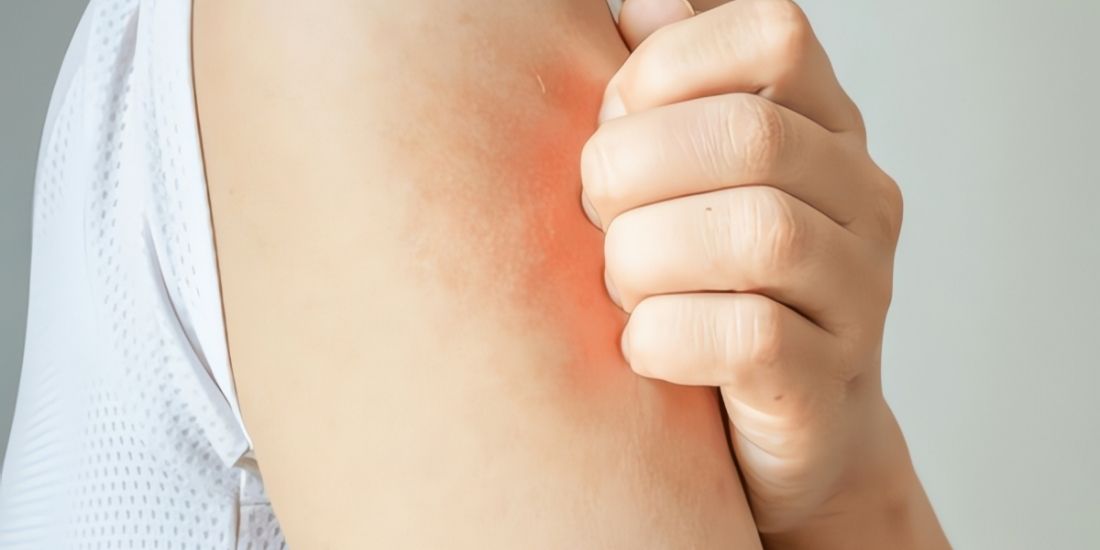 Cilt Kaşıntısında Dermatolog Tedavisi Cilt Kaşıntısında Dermatolog Tedavisi