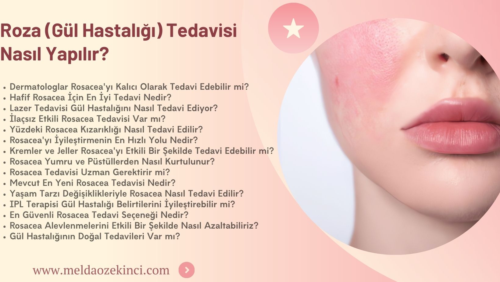 Rosacea (Gül Hastalığı) Nasıl Tedavi Edilir? 