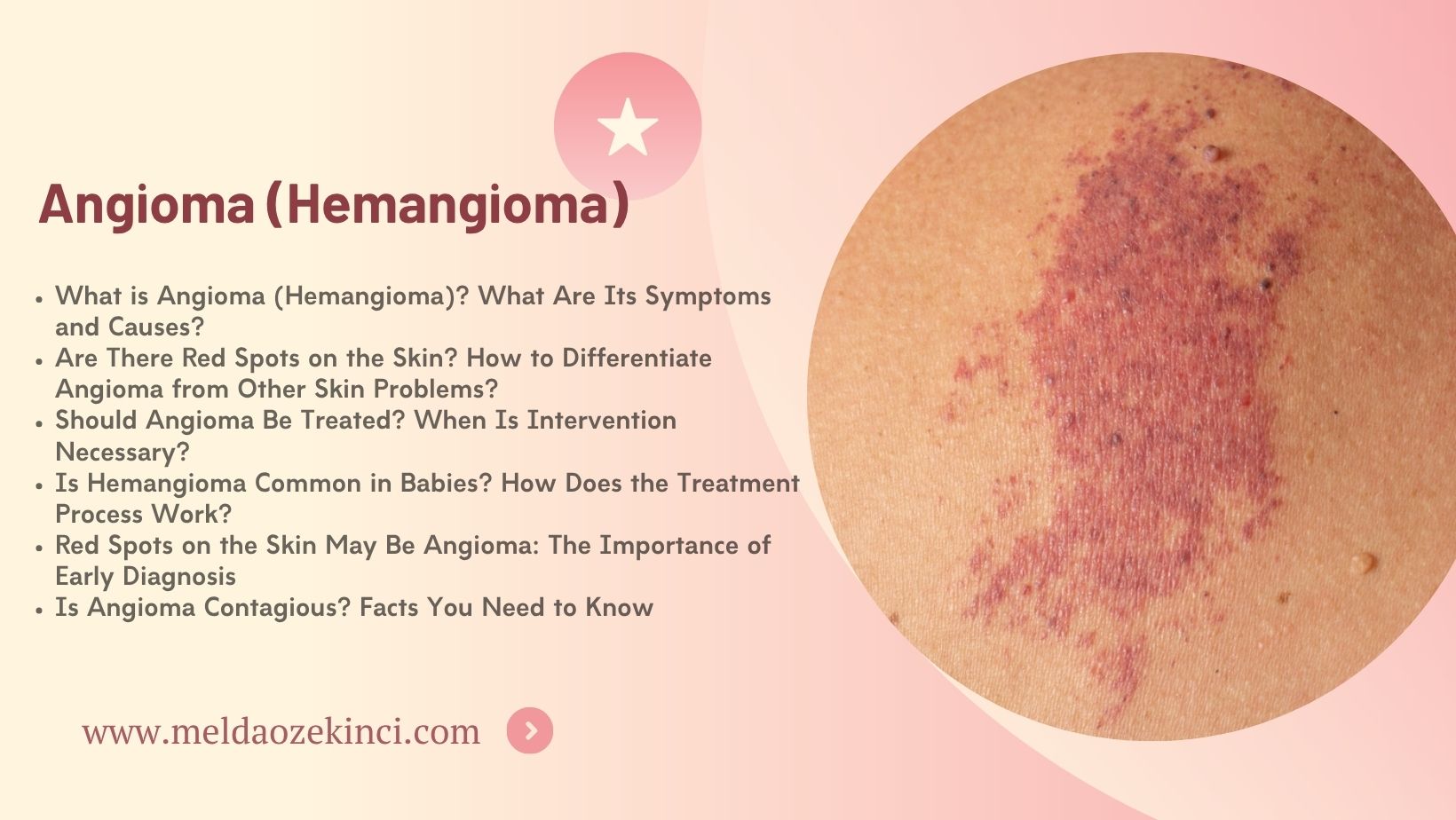 Angioma (Hemangioma)