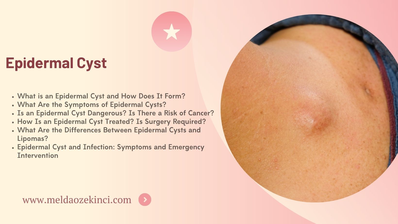Epidermal Cyst