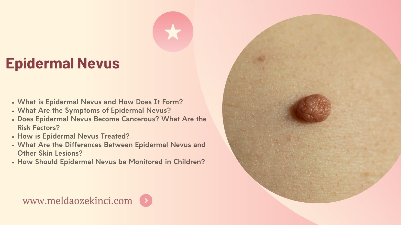 Epidermal Nevus