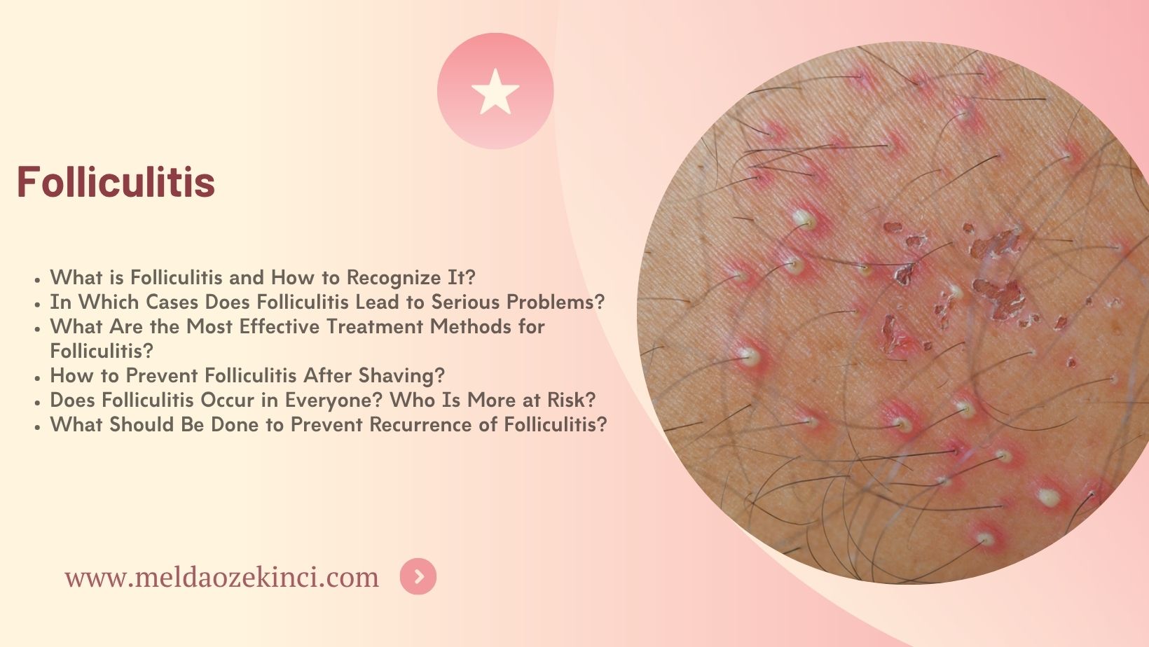 Folliculitis