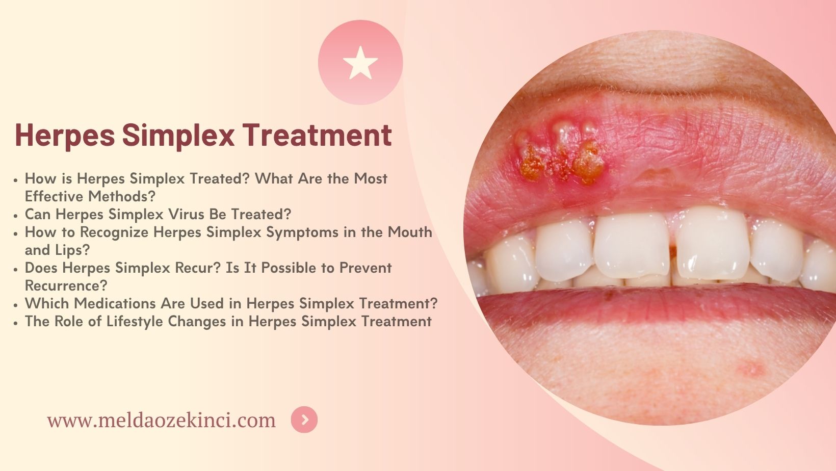 Herpes Simplex Treatment