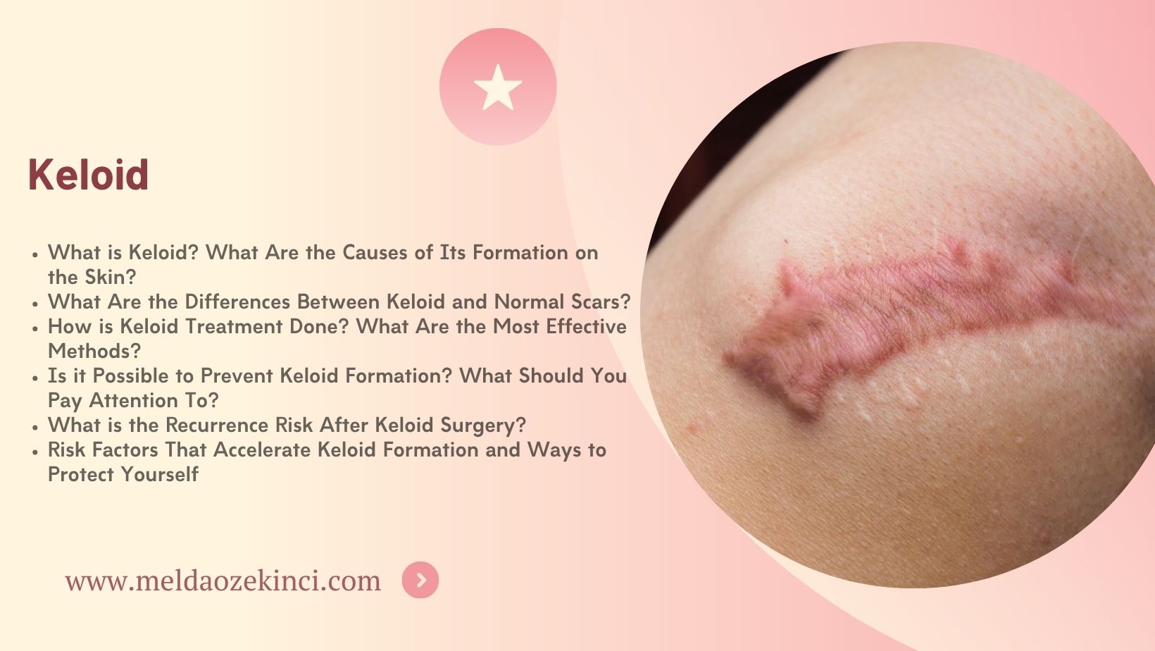 Keloid