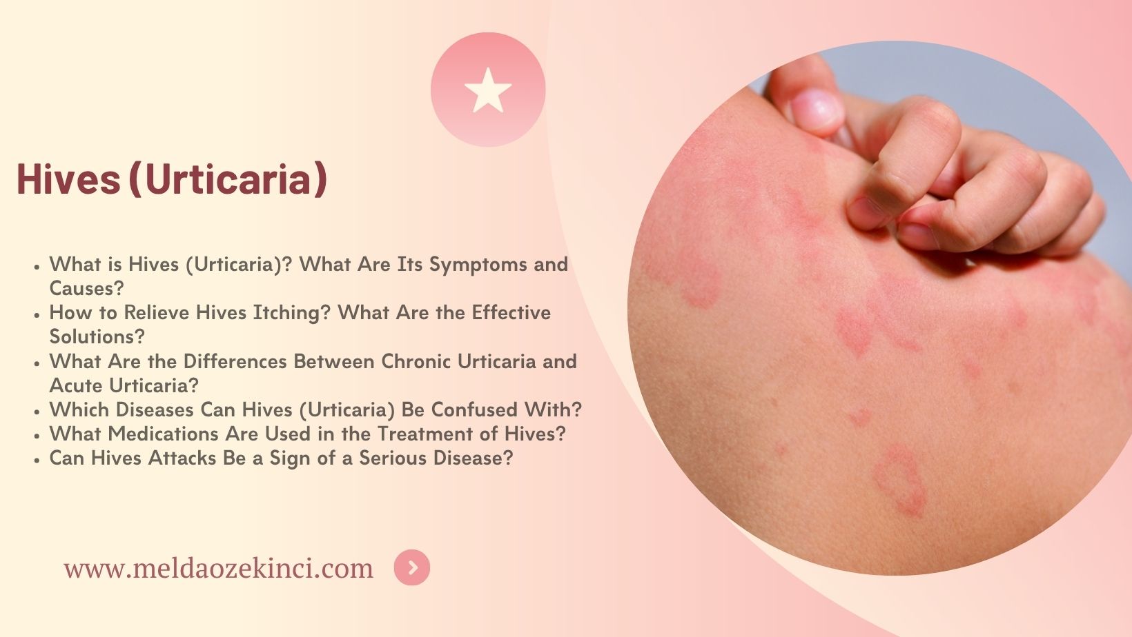 Hives (Urticaria)