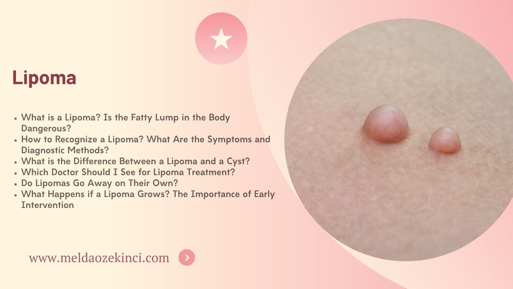 Lipoma