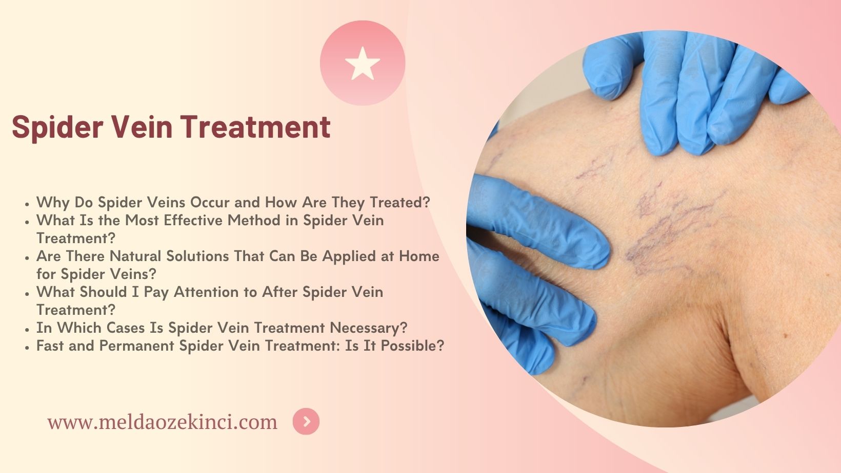 Spider Vein Treatment