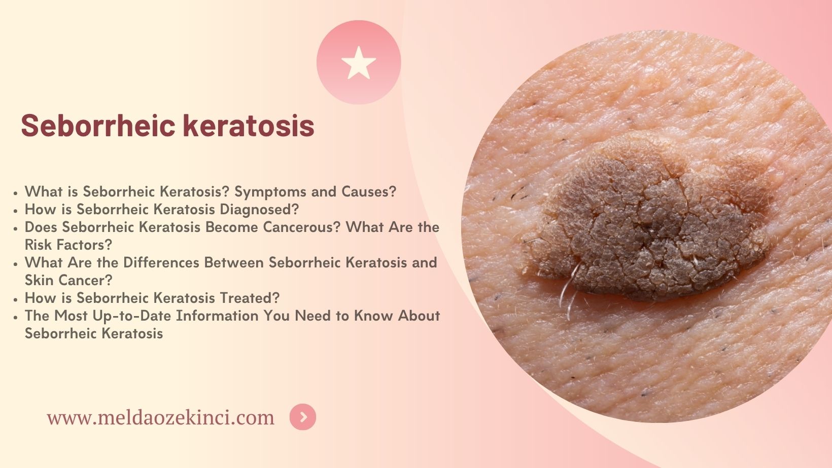Seborrheic keratosis