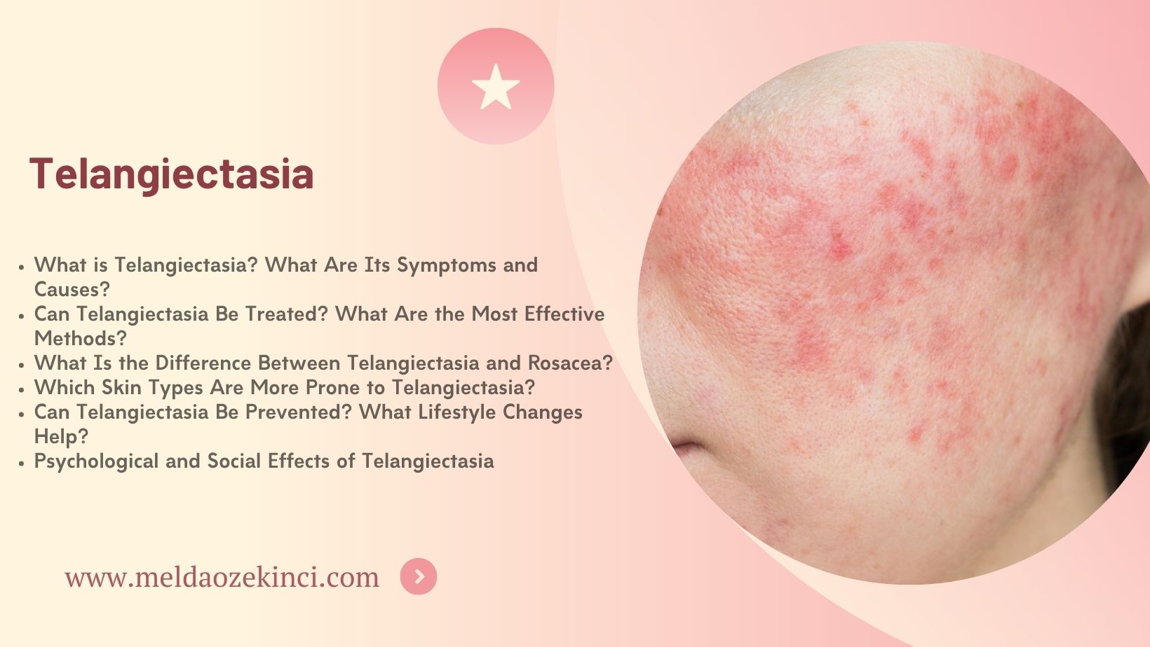 Telangiectasia