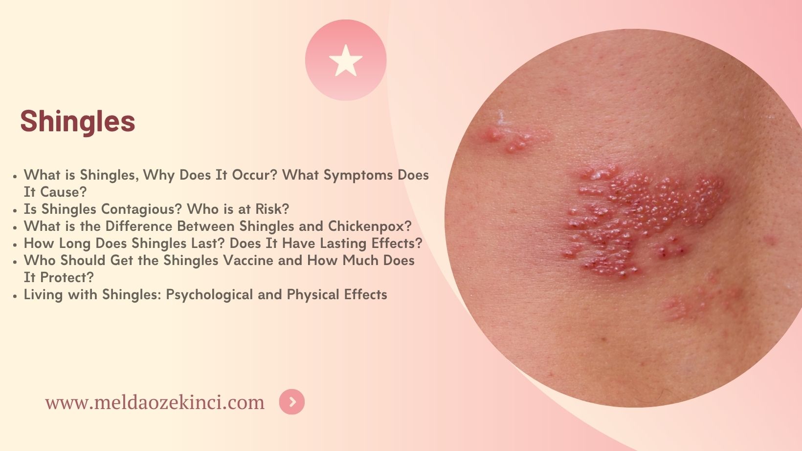 Shingles