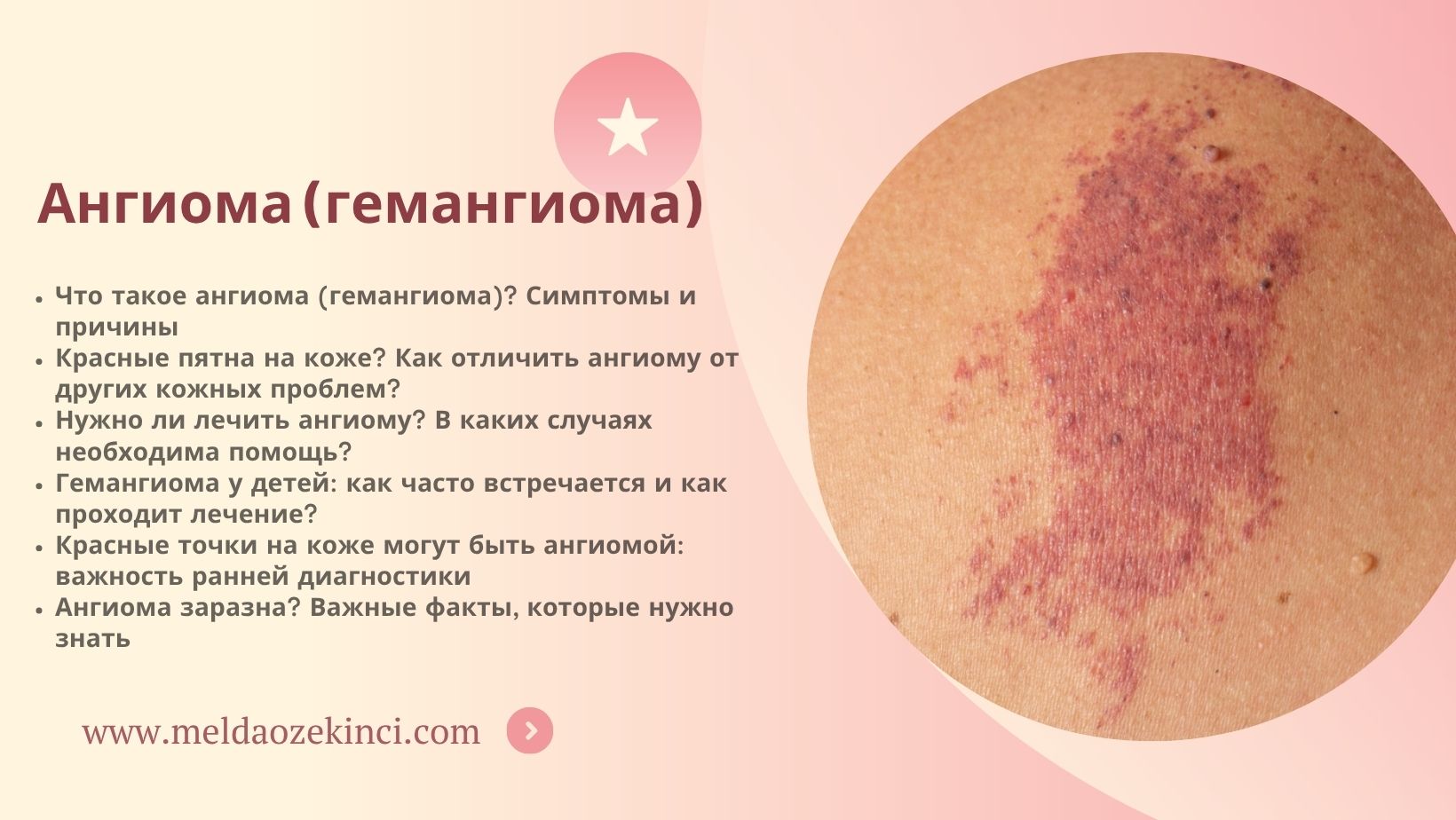 Ангиома (гемангиома)