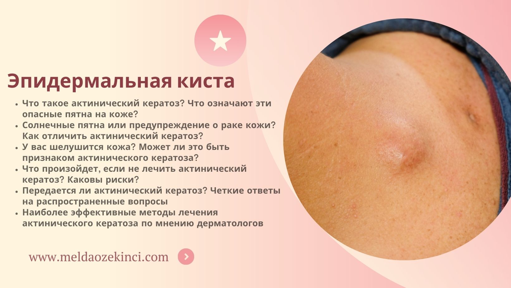 Эпидермальная киста