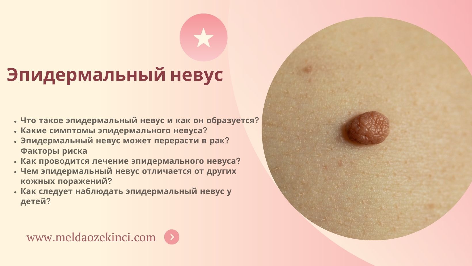 Эпидермальный невус