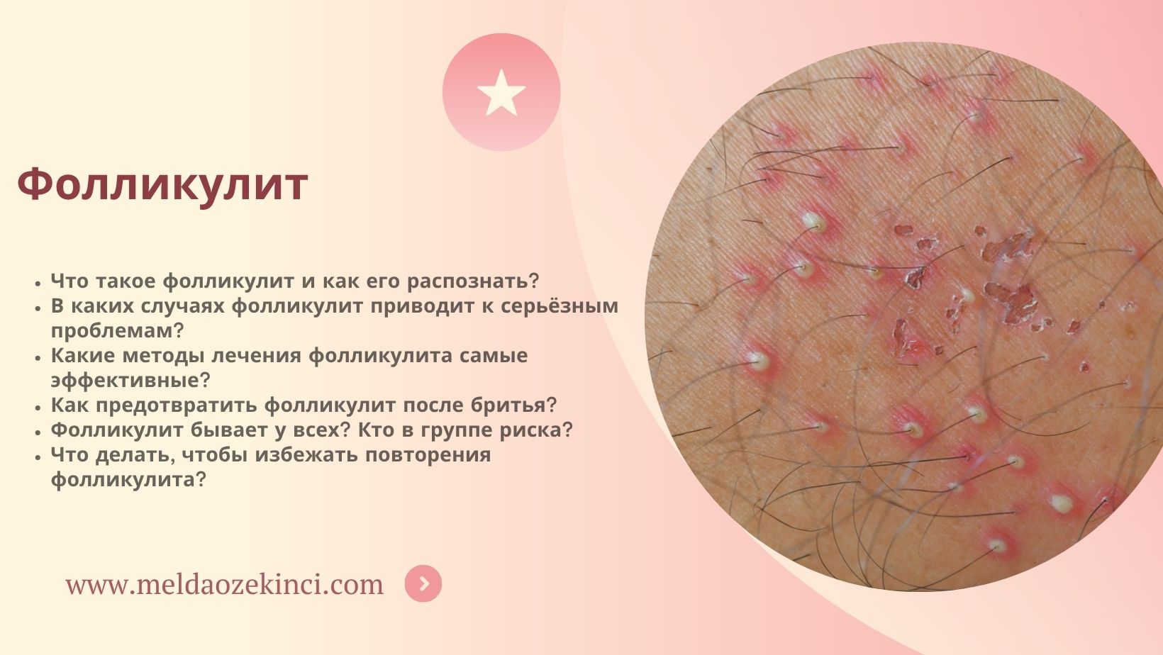 Фолликулит