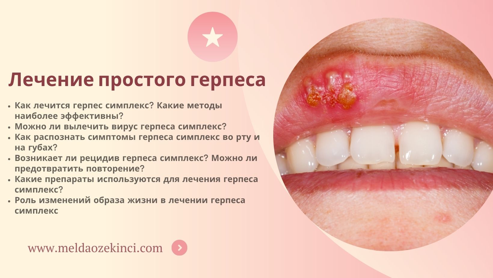 Лечение простого герпеса