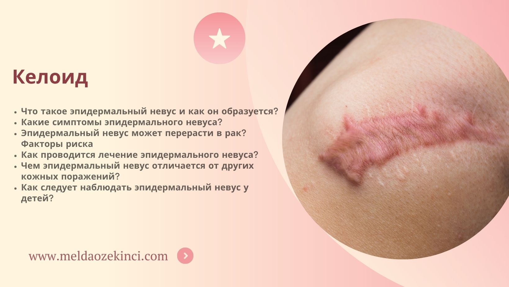 Келоид