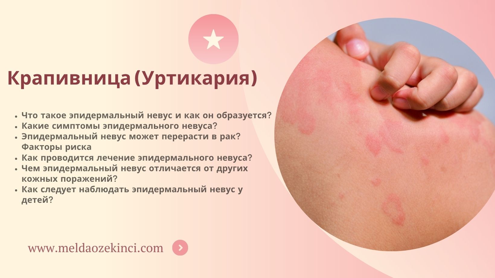 Крапивница (Уртикария)