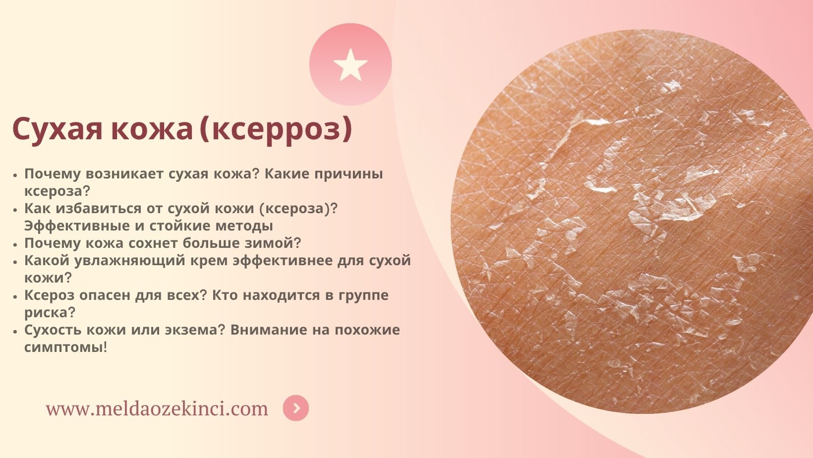 Сухая кожа (ксерроз)