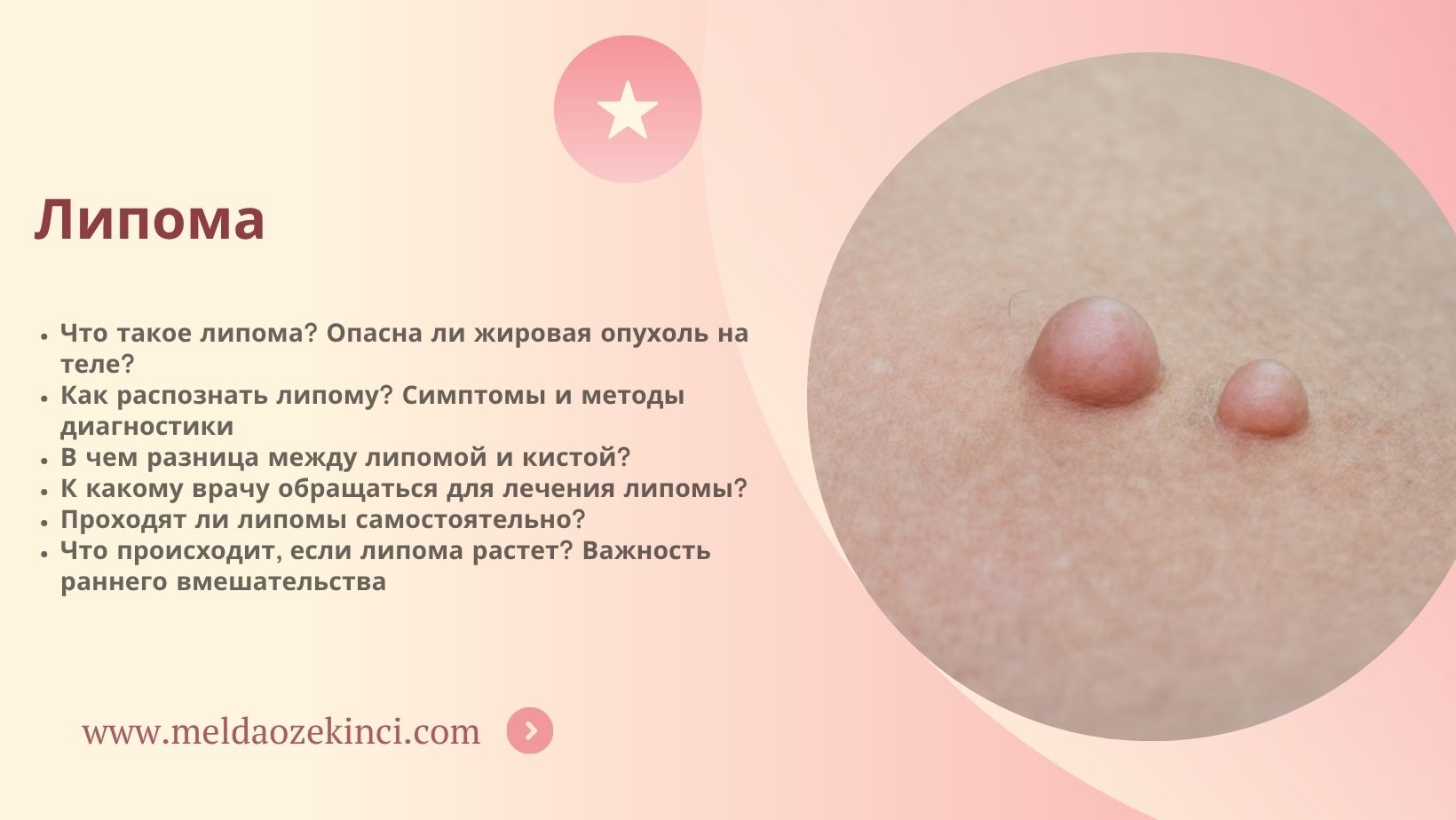 Липома