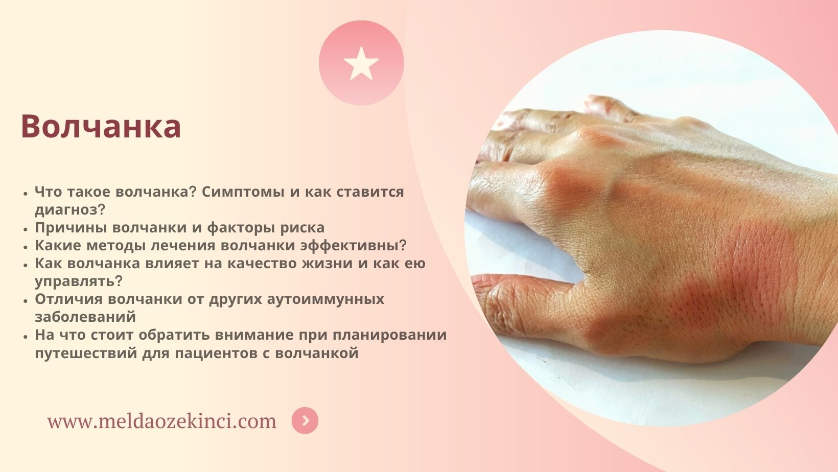 Волчанка