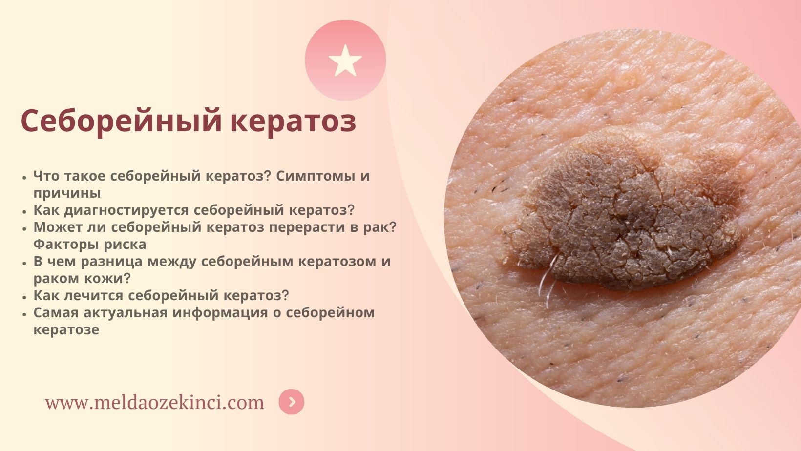 Себорейный кератоз