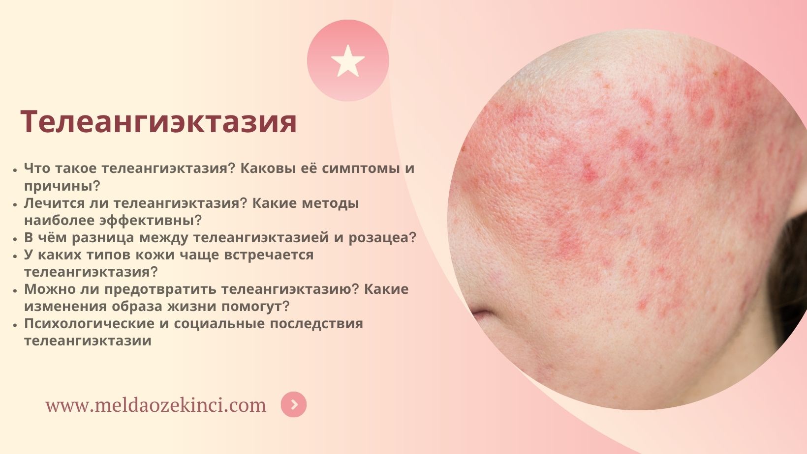 Телеангиэктазия