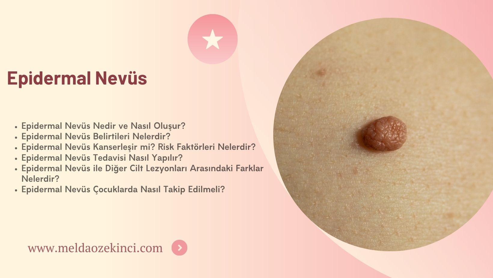 Epidermal Nevüs