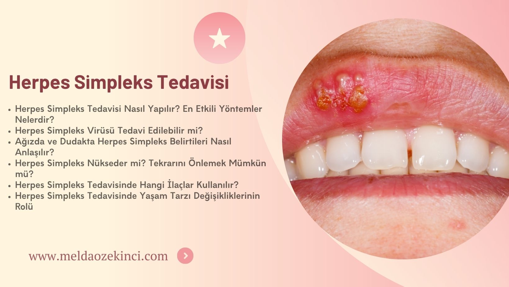 Herpes Simpleks Tedavisi