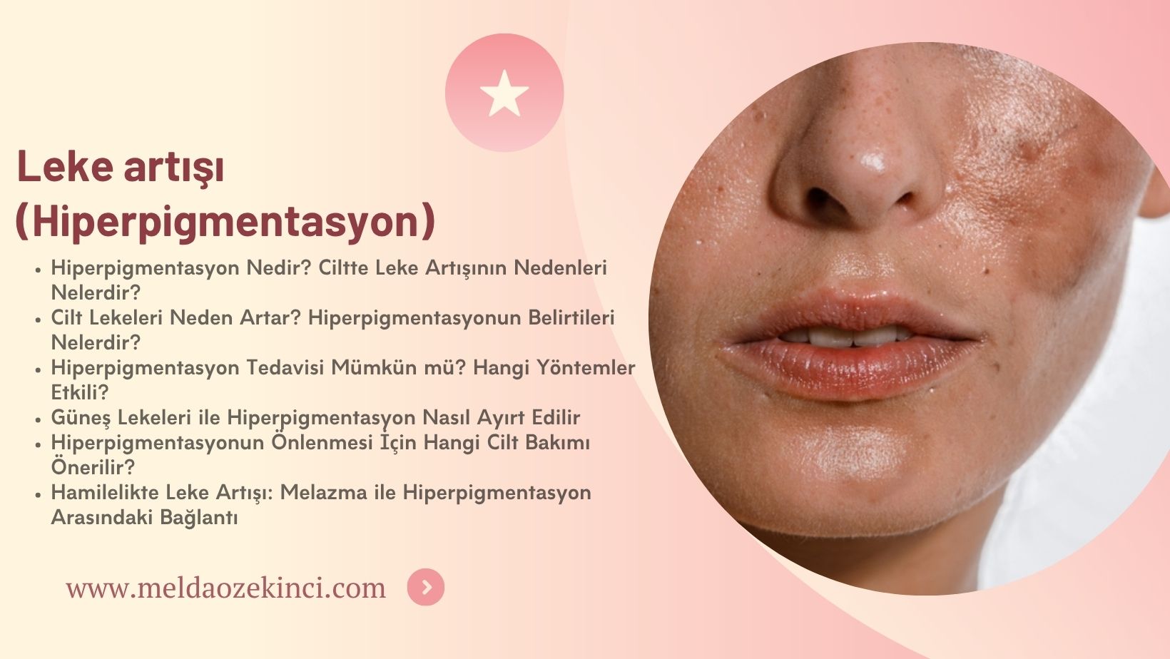 Leke artışı (Hiperpigmentasyon)