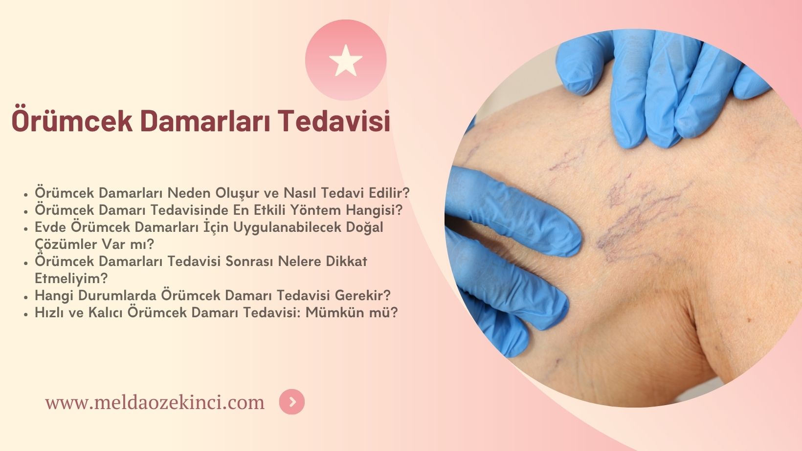 Örümcek Damarları Tedavisi