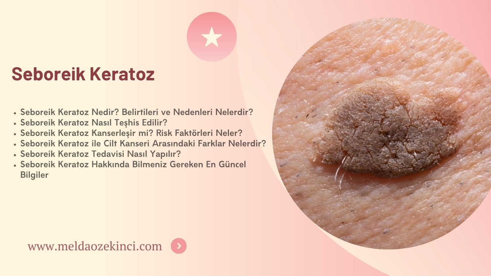 Seboreik Keratoz