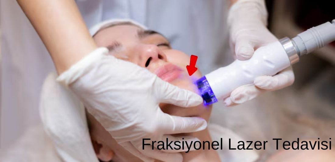 Antalya Fraksiyonel Lazer Tedavisi