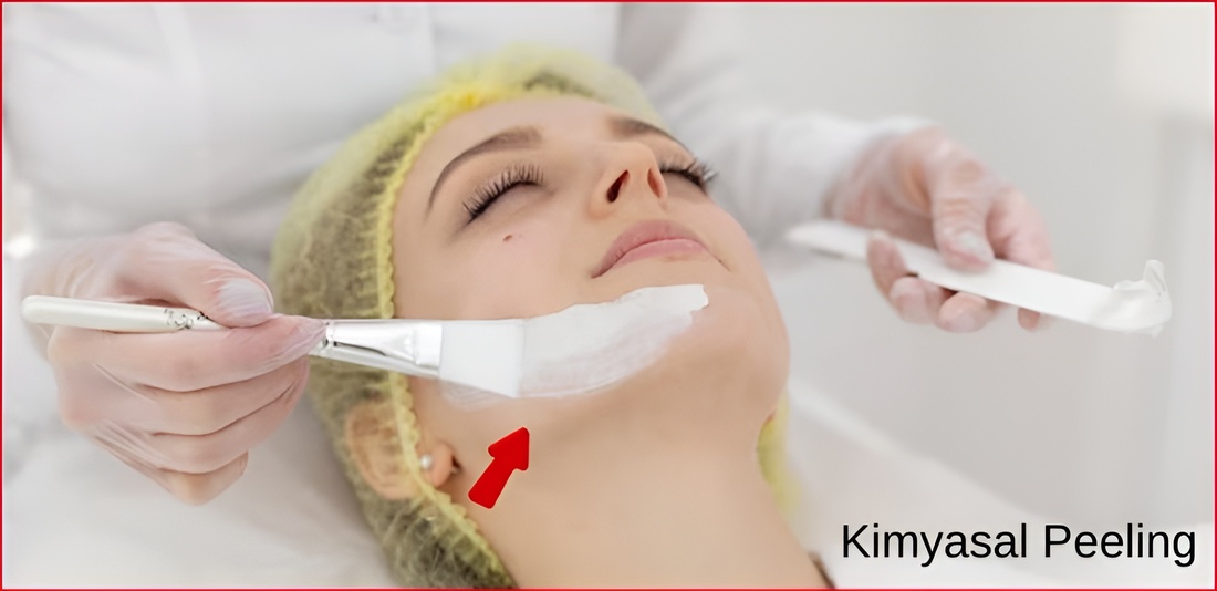 Kimyasal Peeling Nedir?