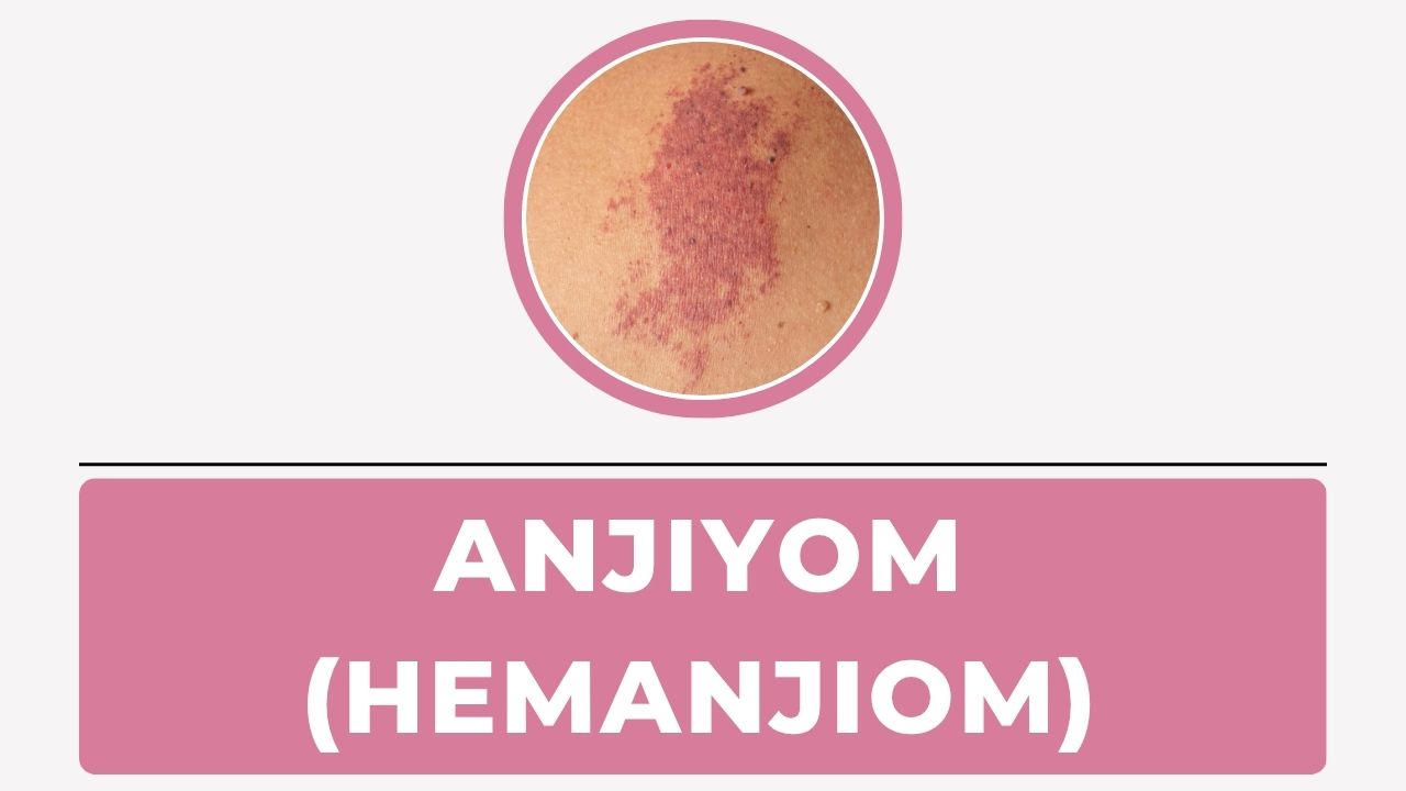 Anjiyom (Hemanjiom)