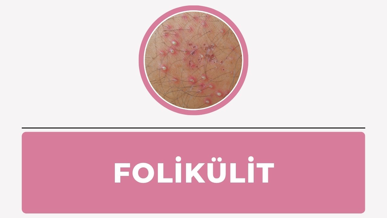 Folikülit