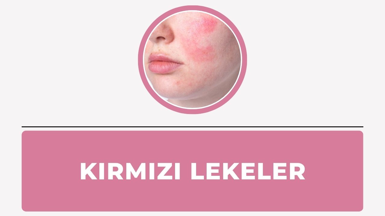 Kırmızı lekeler