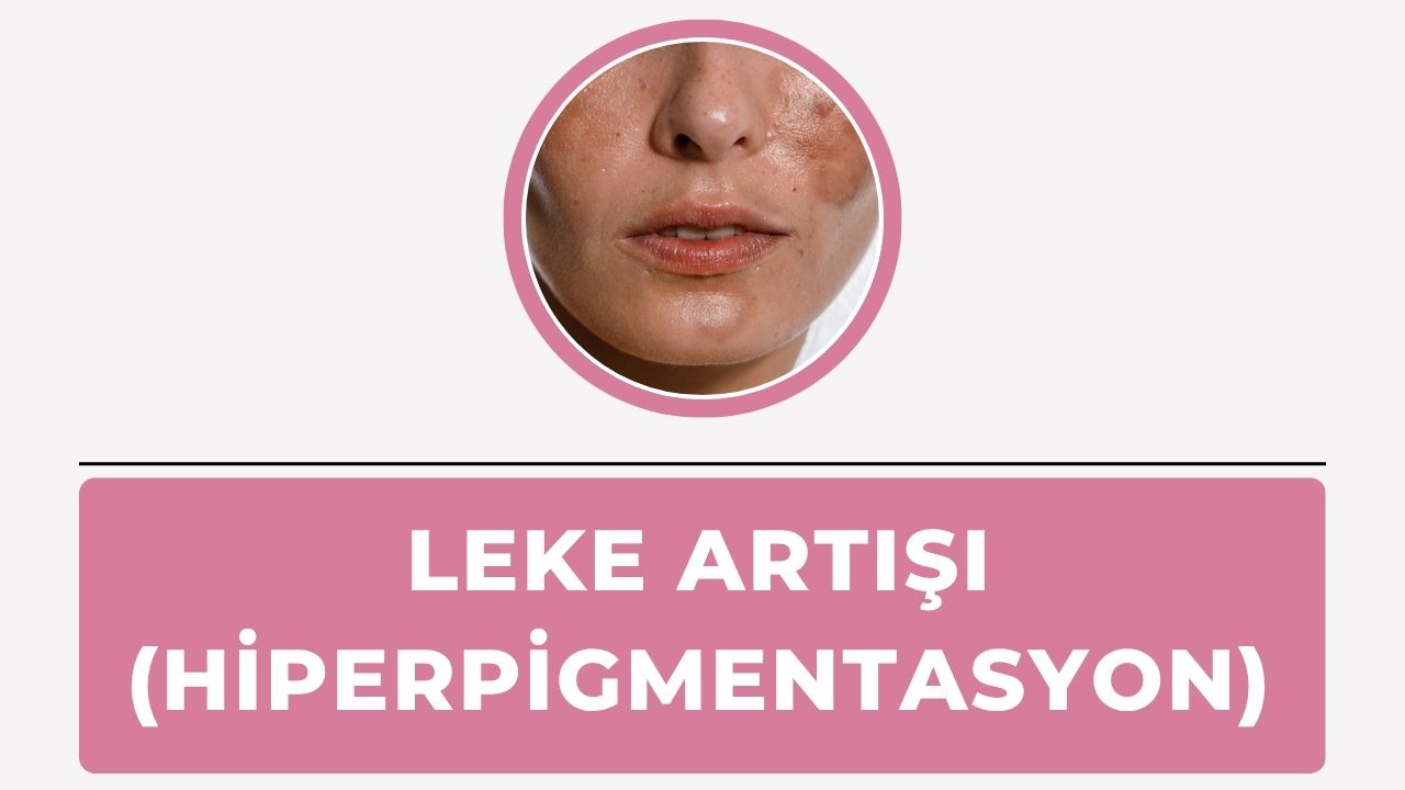 Leke Artışı
