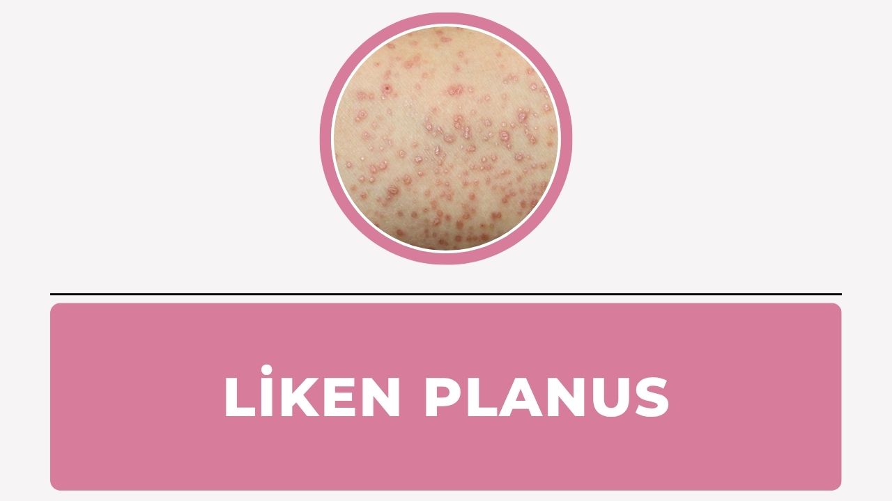 Liken Planus