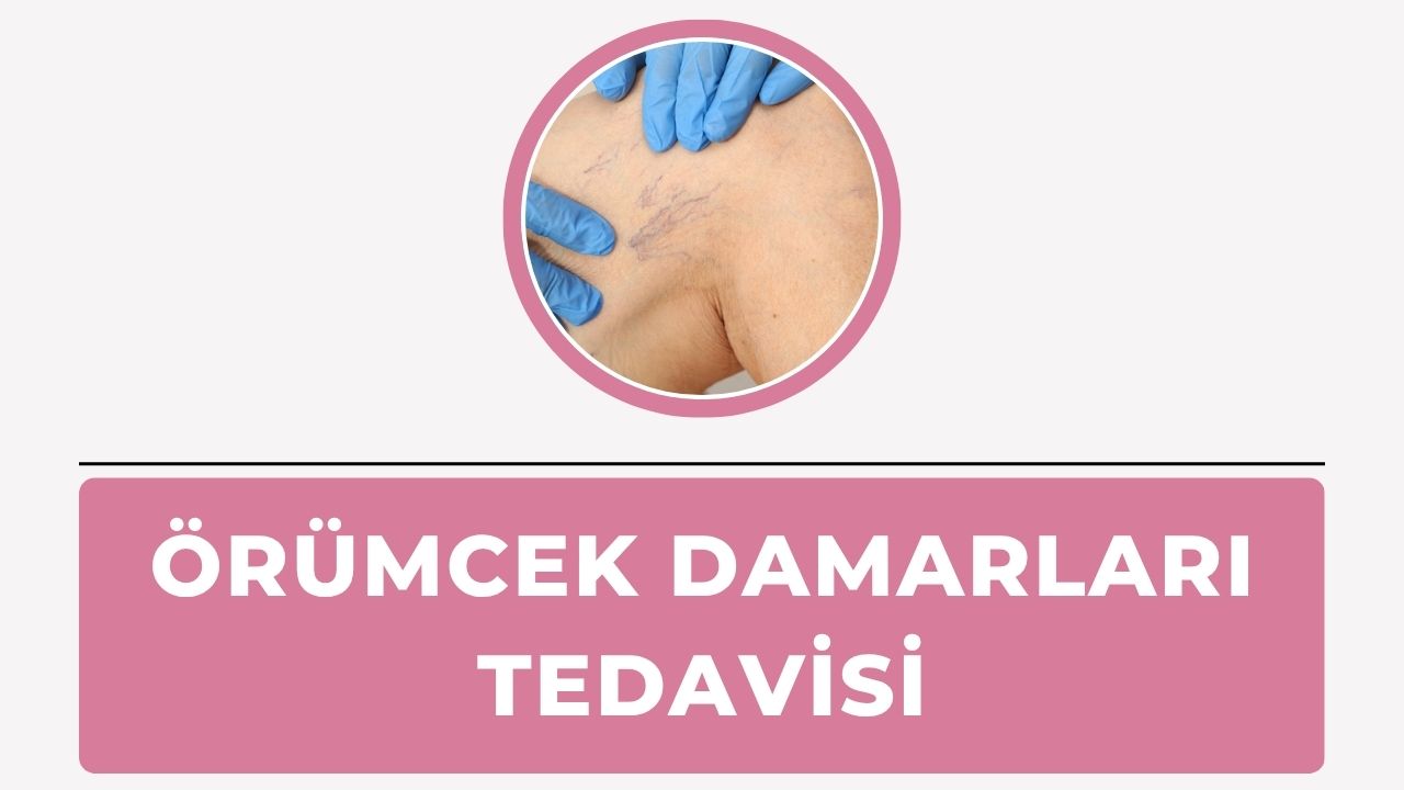 Örümcek Damarları tedavisi