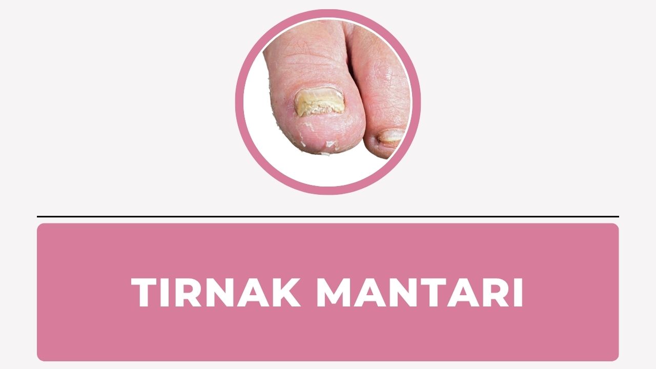 Tırnak mantarı